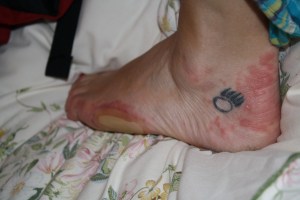 heat rash and blisters