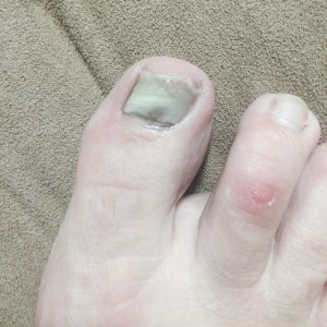 Big toenail going